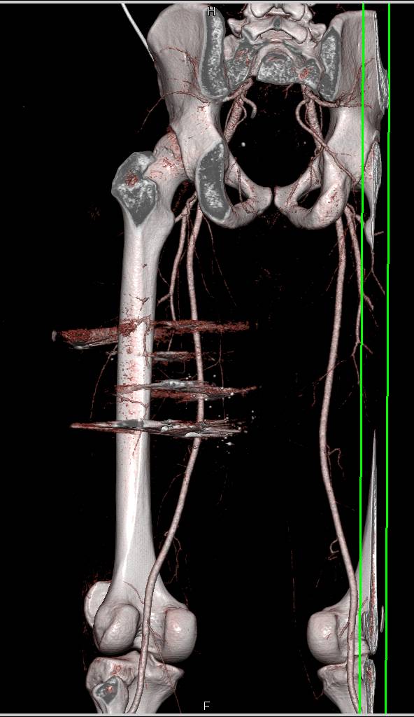 GSW Thigh without Vascular Injury as Shown on CTA of the Lower Extremities - CTisus CT Scan