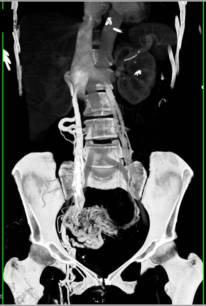 Pelvic Arteriovenous Malformation (AVM) with Vascular Flow Pattern - CTisus CT Scan