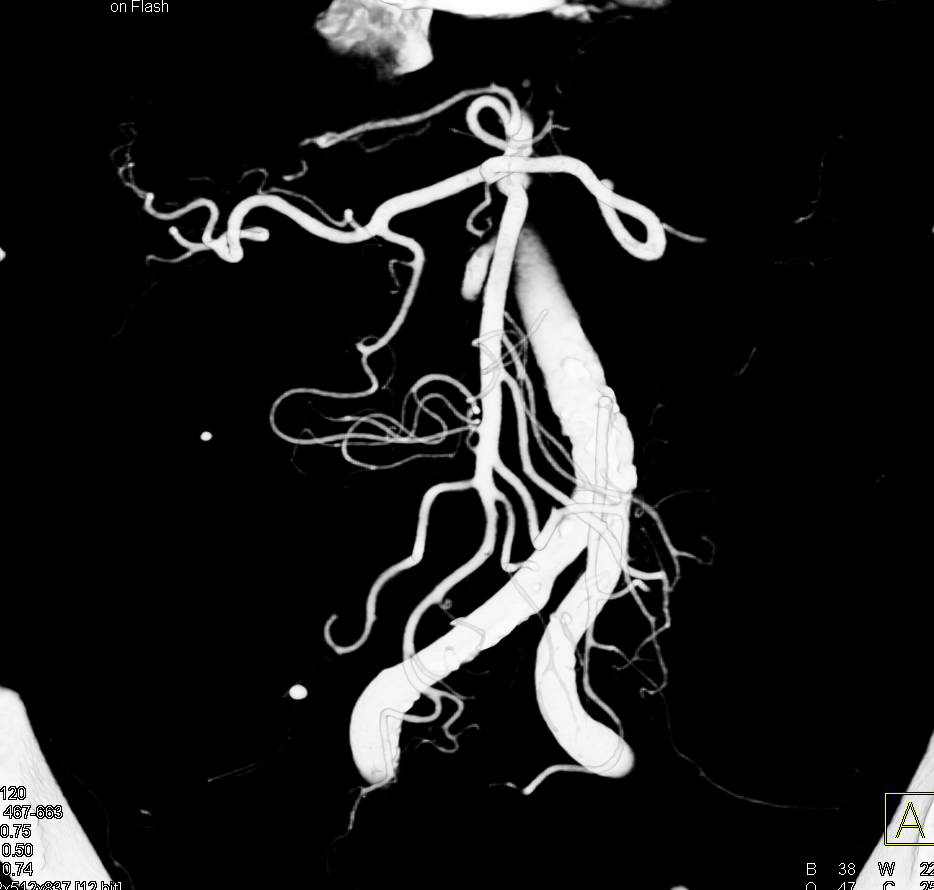 Superior Mesenteric Artery (SMA) Mapping with VRT and MIP - CTisus CT Scan