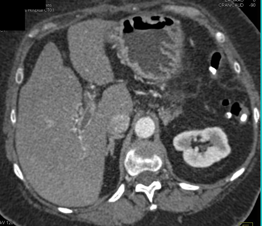 Portal Vein and Superior Mesenteric Vein (SMV) Thrombosis - CTisus CT Scan