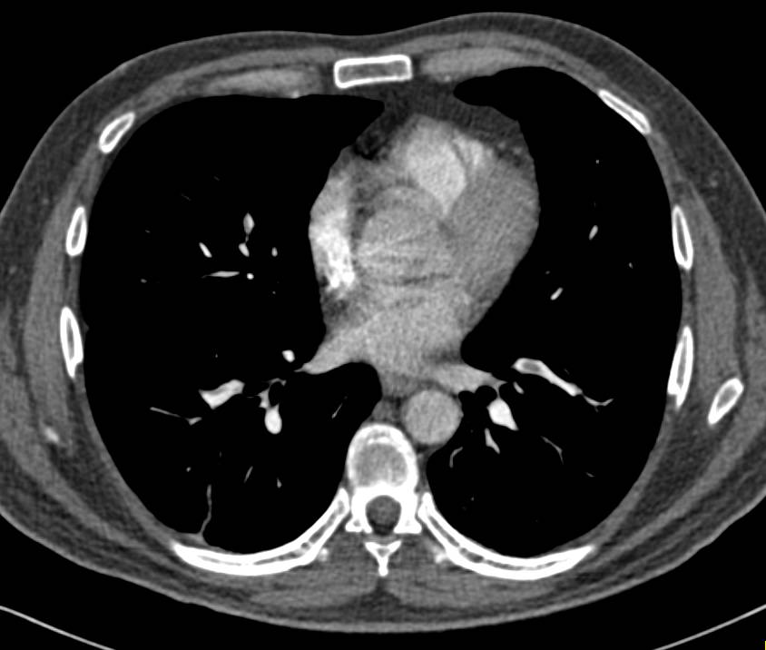 Pulmonary Embolism (PE) in Patient with Multiple Thrombi in Inferior Vena Cava (IVC) and Femoral Veins and Iliac Veins as well as Superior Mesenteric Vein (SMV) in Patient with Early Ischemic Bowel - CTisus CT Scan