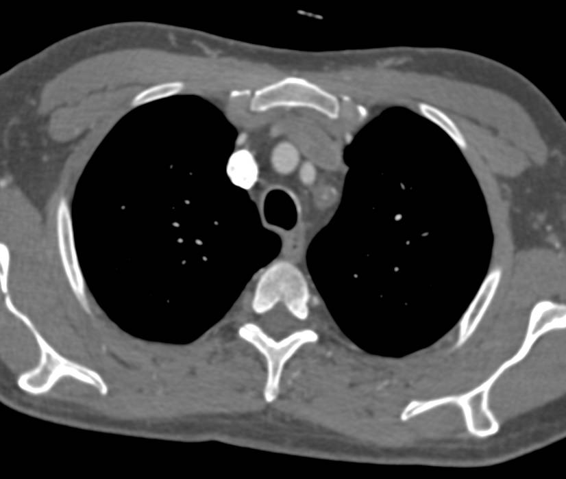 Occlusion of the Proximal Left Subclavian Artery - CTisus CT Scan