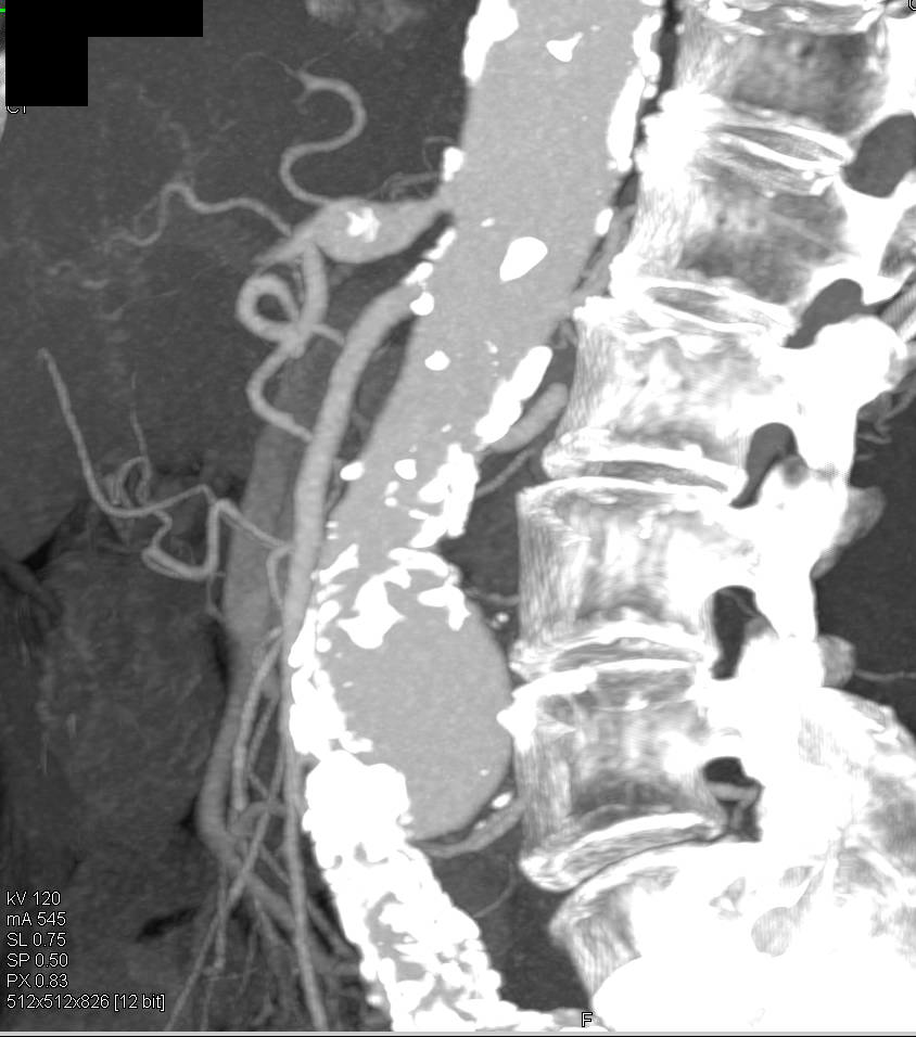 Abdominal Aortic Aneurysm with Vascular Mapping and Median Arcuate Ligament Syndrome - CTisus CT Scan