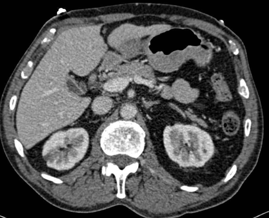 Inferior Vena Cava (IVC) Clot - CTisus CT Scan