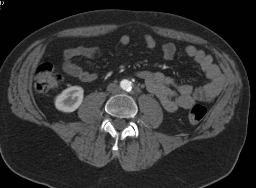 Runoff with Patent Graft on the Right and Occluded Stents on the Left - CTisus CT Scan