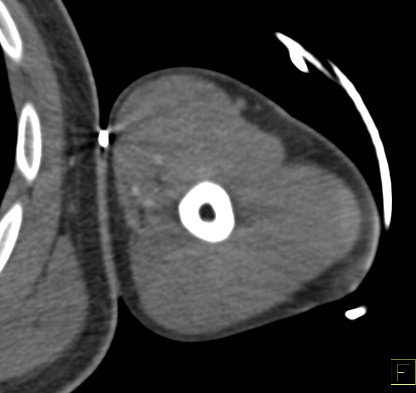 Stab Wound with Injury to Brachial Artery - CTisus CT Scan