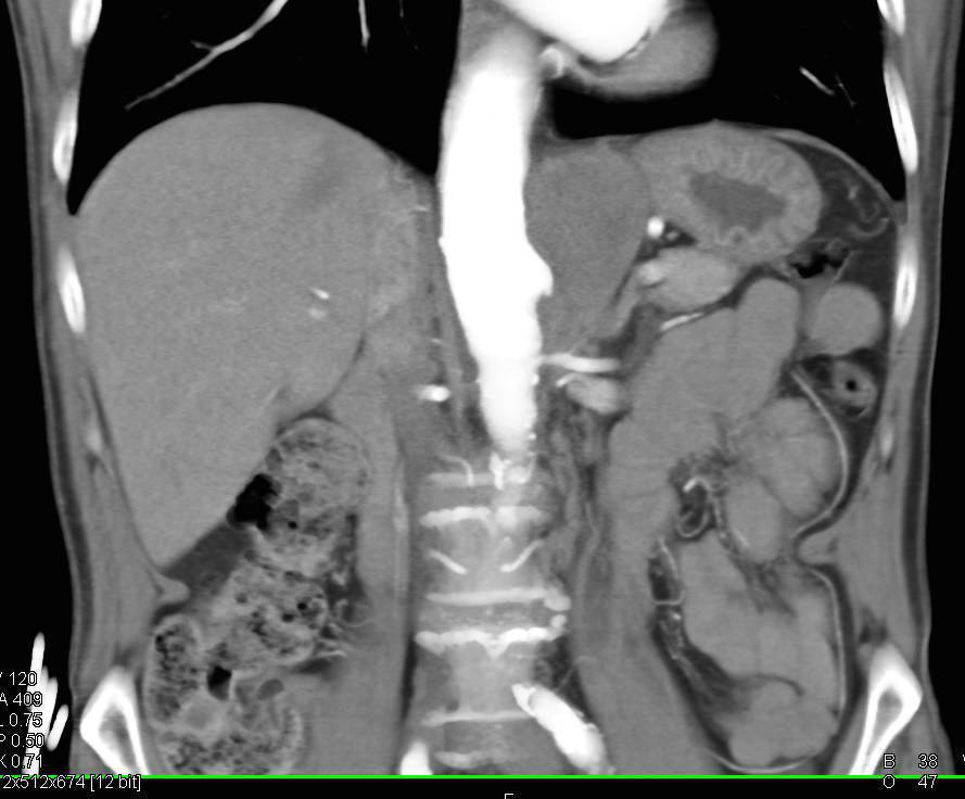 Ulceration Descending Aorta with Intramural Hematoma (IMH) - CTisus CT Scan