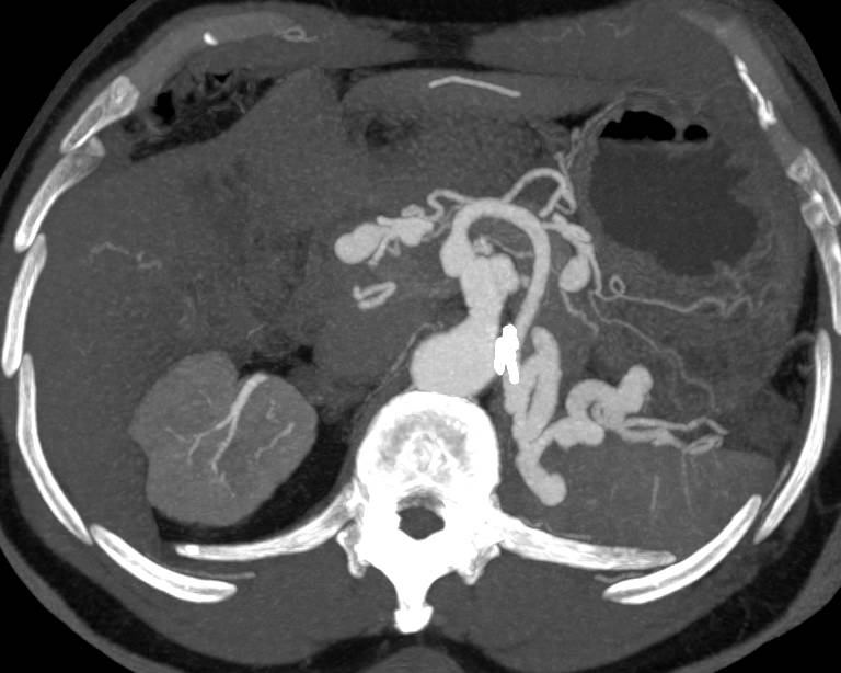 Unusual case of Incidentally Discovered Vascular processes Including Mesenteric Aneurysms , Focal Stenosis and vasculitis - CTisus CT Scan