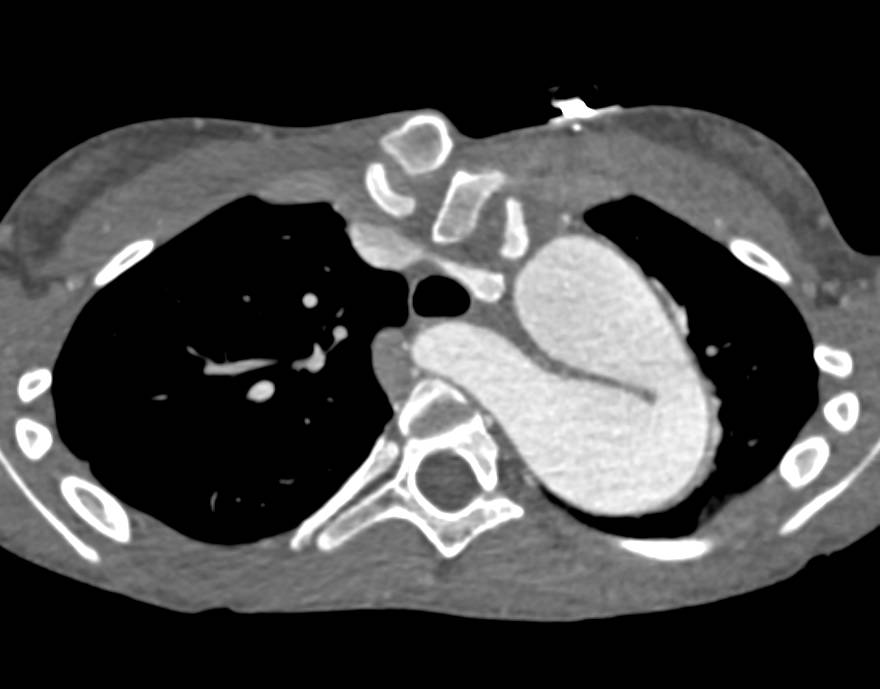 Type A Dissection Repair with High Aortic Arch - CTisus CT Scan