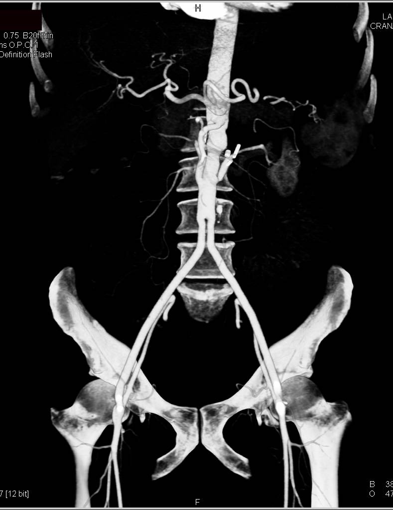 Aortic Aneurysm with Repair and Reimplanted Renal Arteries and Mesenteric Vessels - CTisus CT Scan