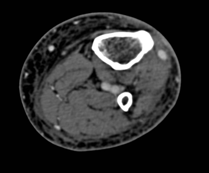 CTA with Small Vascular Malformation - CTisus CT Scan