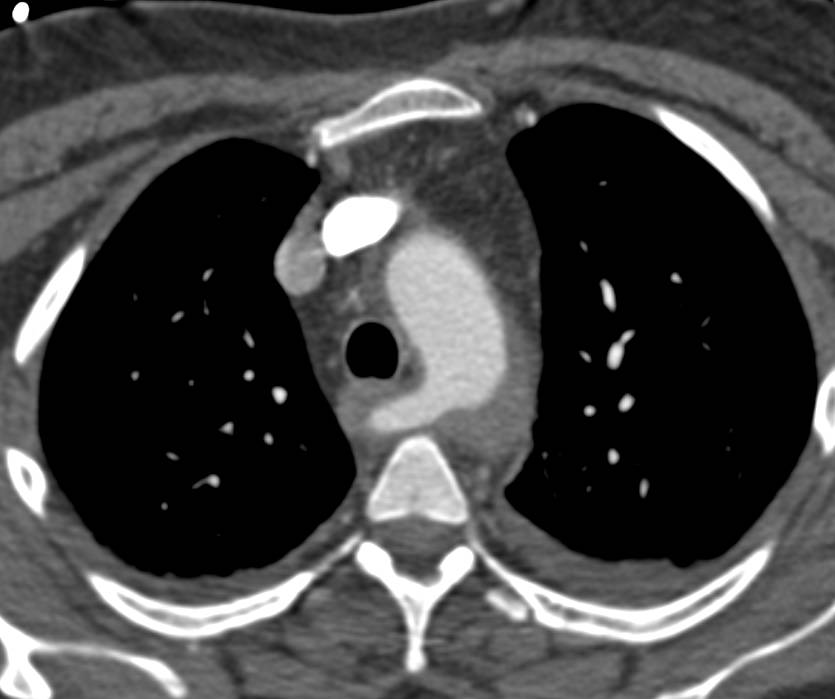 Intramural Hematoma with Dissection Extending from Thoracic to Abdominal Aorta. Aberrant right subclavian aa seen - CTisus CT Scan