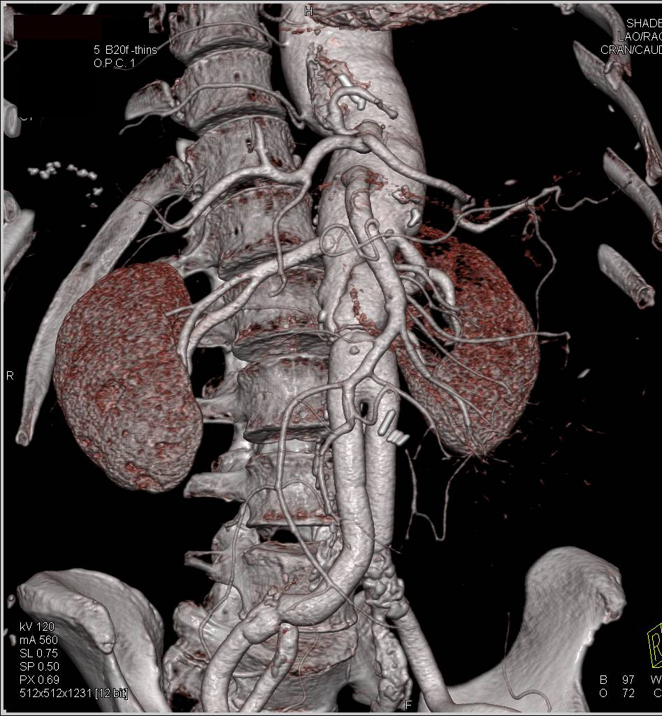 Repair Ascending Aorta As Well As Abdominal Aorta With Dissection