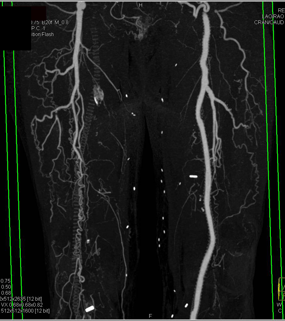 CTA Runoffs with Bypass Grafts with Right Sided Graft Occluded. Bone editing Nicely Defined - CTisus CT Scan