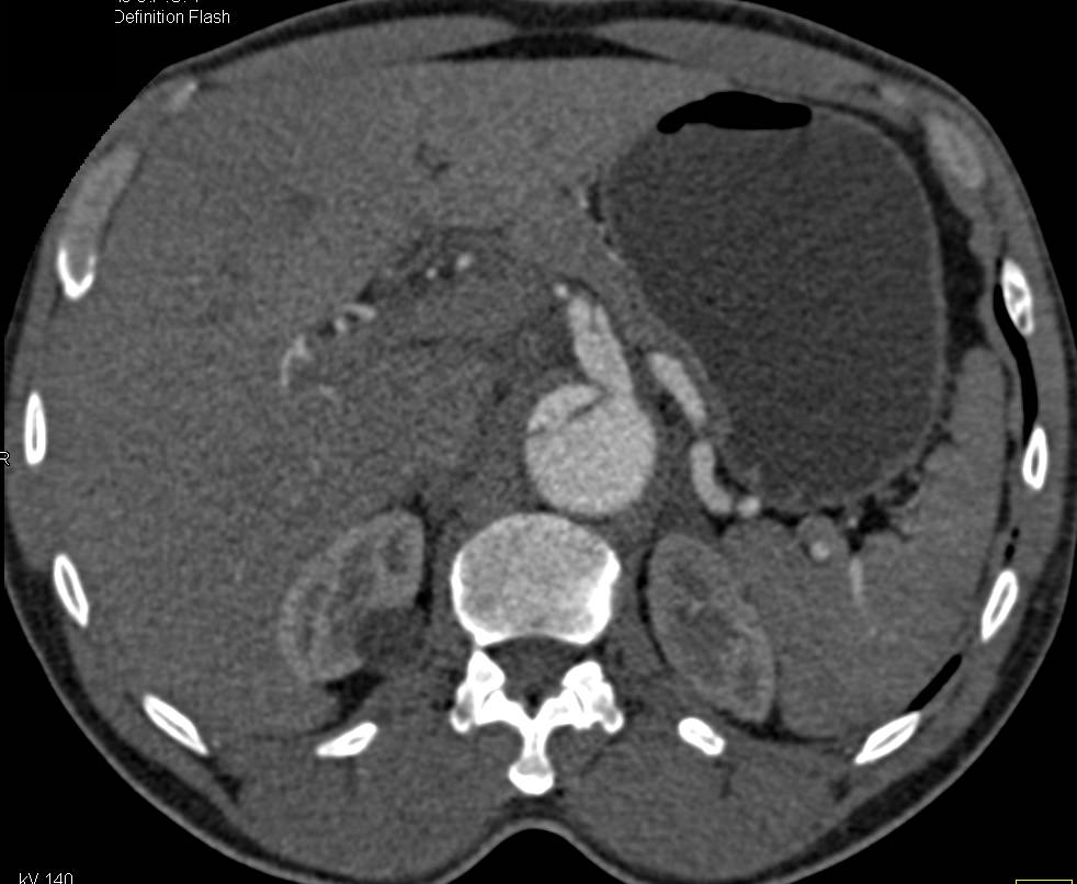 Aortic Dissection Extends into the Celiac Axis - CTisus CT Scan