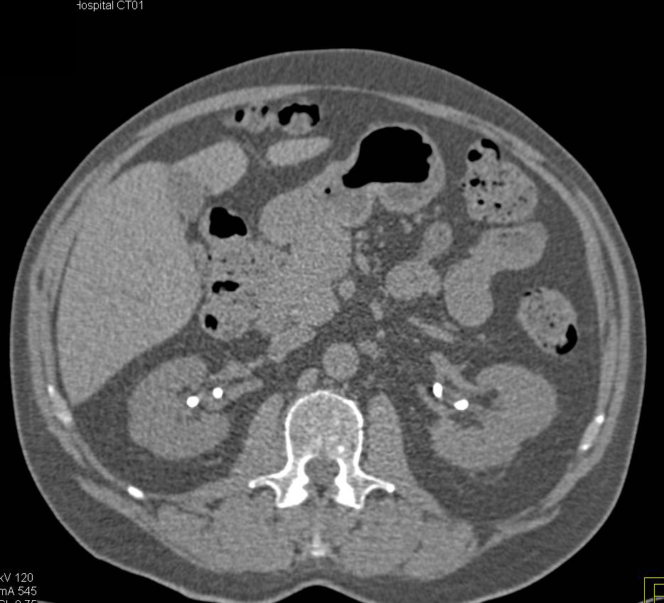 Retroperitoneal Fibrosis (RPF) Encases the Aorta and iliac Arteries as well as the Ureters Bilaterally - CTisus CT Scan