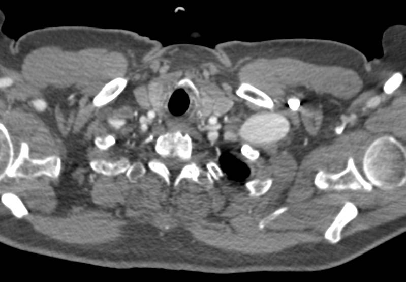 Left Axillary Artery Aneurysm - CTisus CT Scan