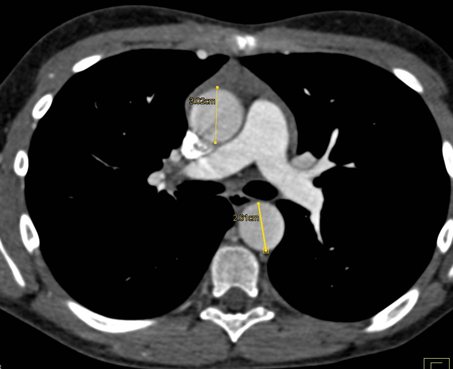 Coarctation of the Aorta with Increased Flow through the Internal Mammary Artery - CTisus CT Scan