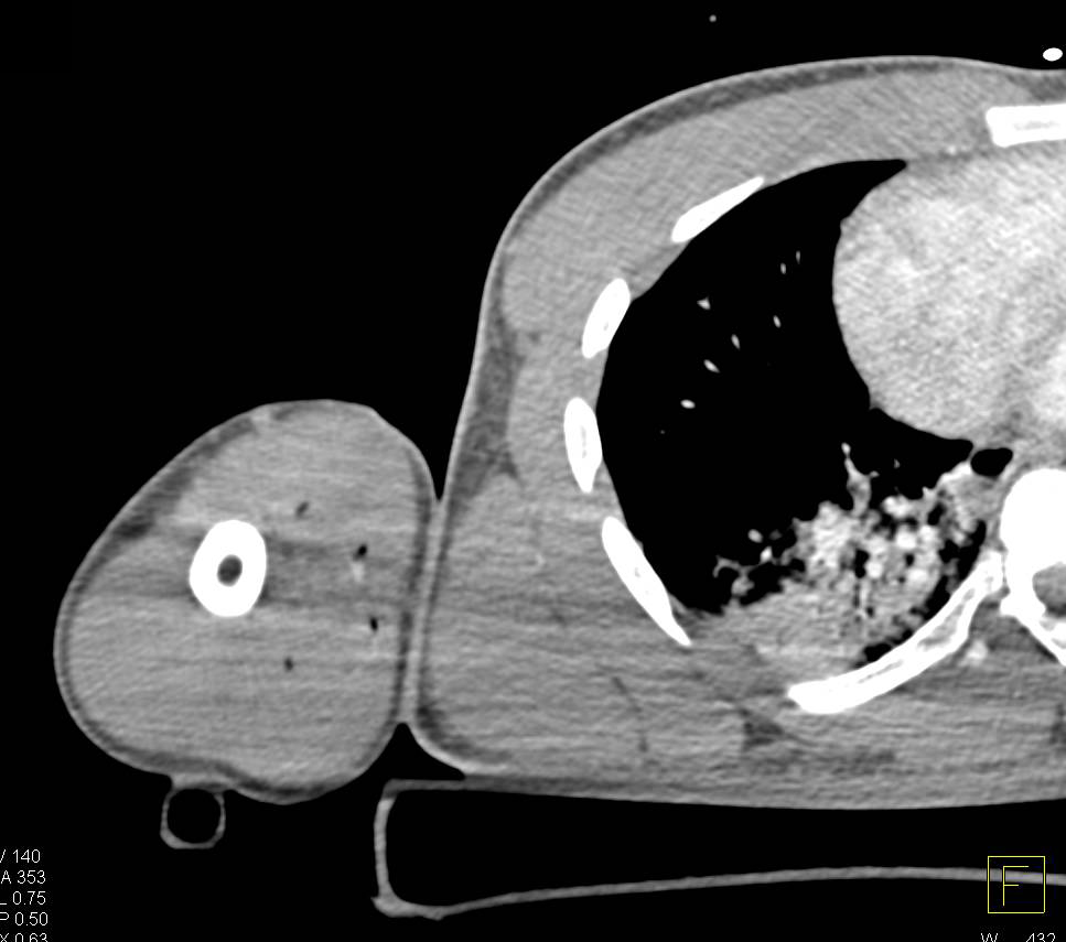 GSW Axilla with Injury to Brachial Artery - CTisus CT Scan