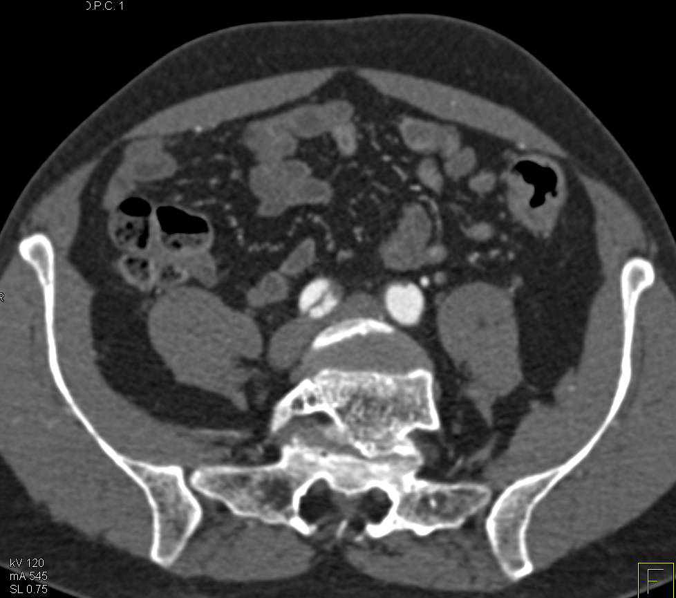 Focal Dissection of the Common Iliac Arteries Bilaterally - CTisus CT Scan