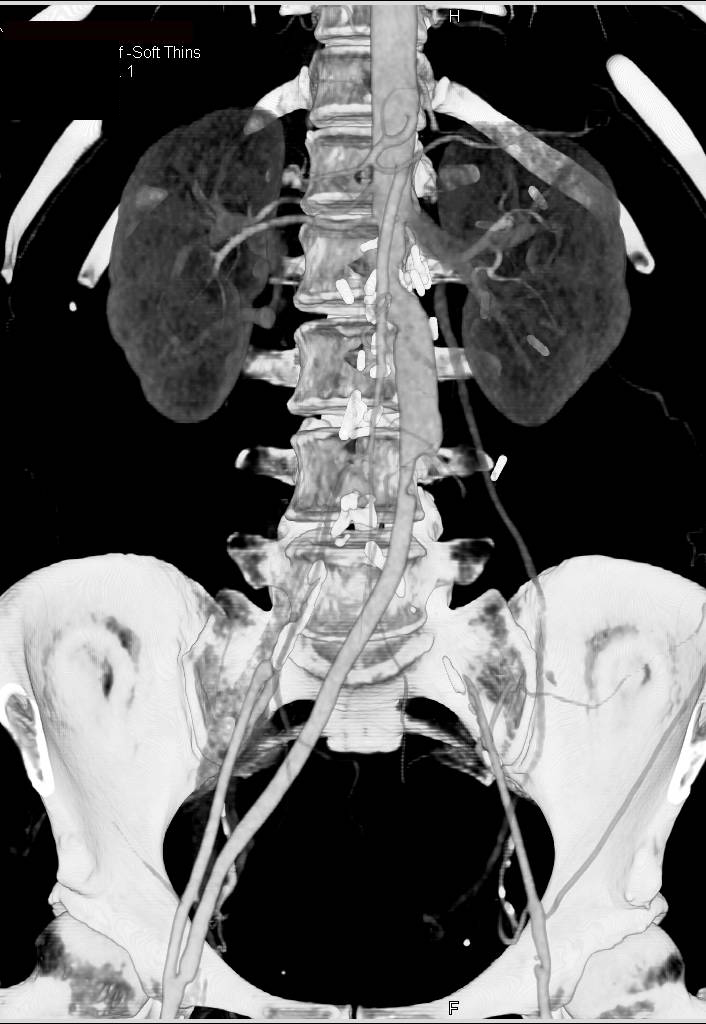 Thrombus in Aorta Above Bifurcation with Occlusion of the Left Common Iliac Artery - CTisus CT Scan