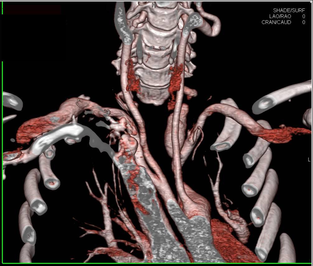 Aneurysmal Dilatation of Left Vertebral Artery - CTisus CT Scan