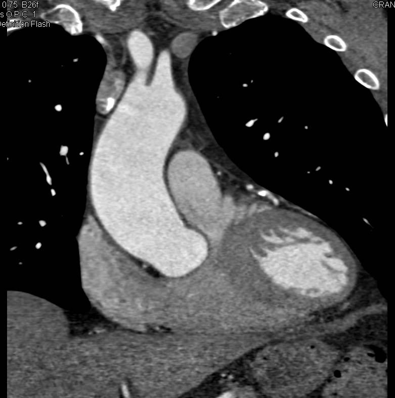 Dilated Ascending Aorta with Coronary Artery Disease. Vessel Tracking is Used for Optimal Mapping and Measurement - CTisus CT Scan