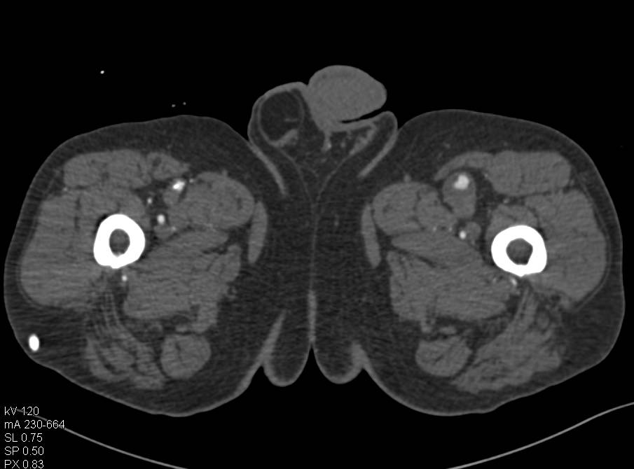 Excellent Example of a CTA Runoff with Peripheral Vascular Disease (PVD) and Stents, Stenosis and Even A Pseudoaneurysm or Two - CTisus CT Scan