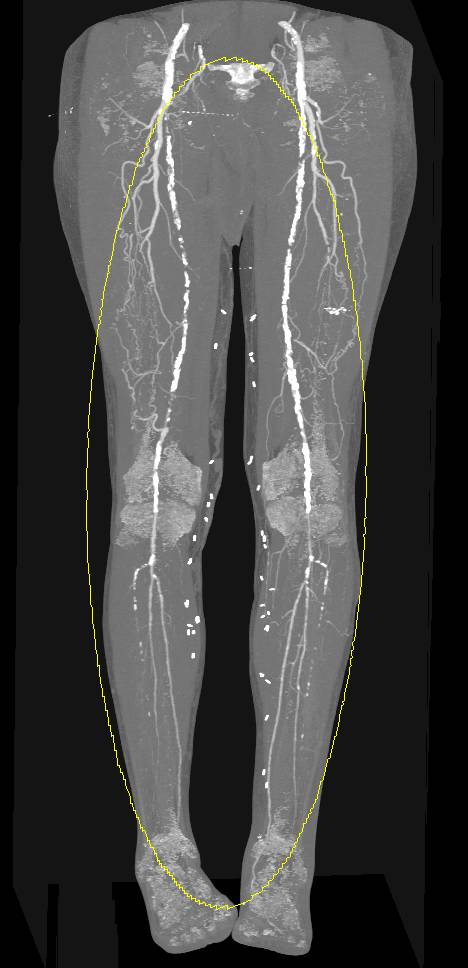 CTA Runoff with Dual Energy and Dual Energy with Calcium Removal - CTisus CT Scan