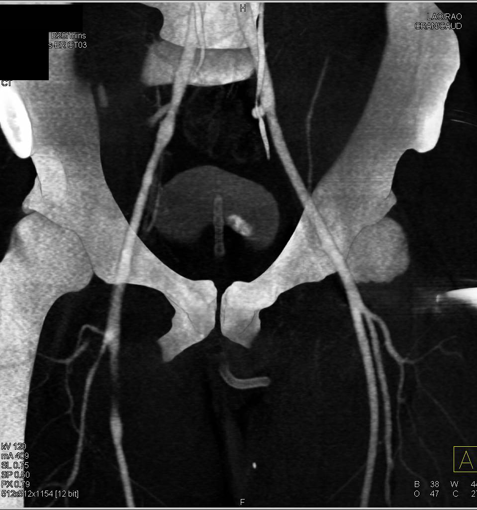 CTA Mapping the the Superficial Femoral Arteries (SFAs) - CTisus CT Scan