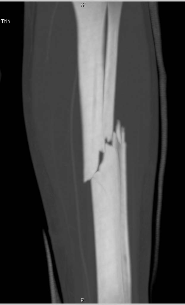 Tibia and Fibular Fractures Without Vascular Injury on Runoff Study - CTisus CT Scan