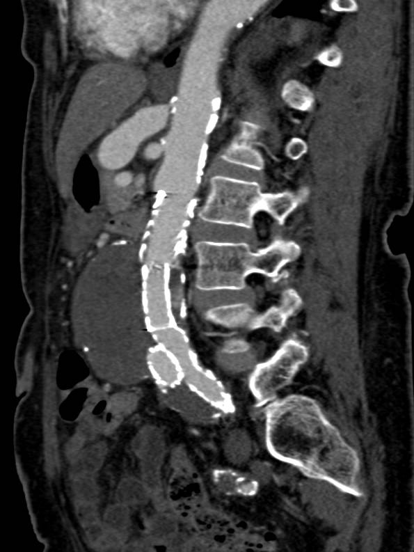 Celiac Artery Aneurysm in a Patient with an Endovascular Stent and an Endoleak - CTisus CT Scan