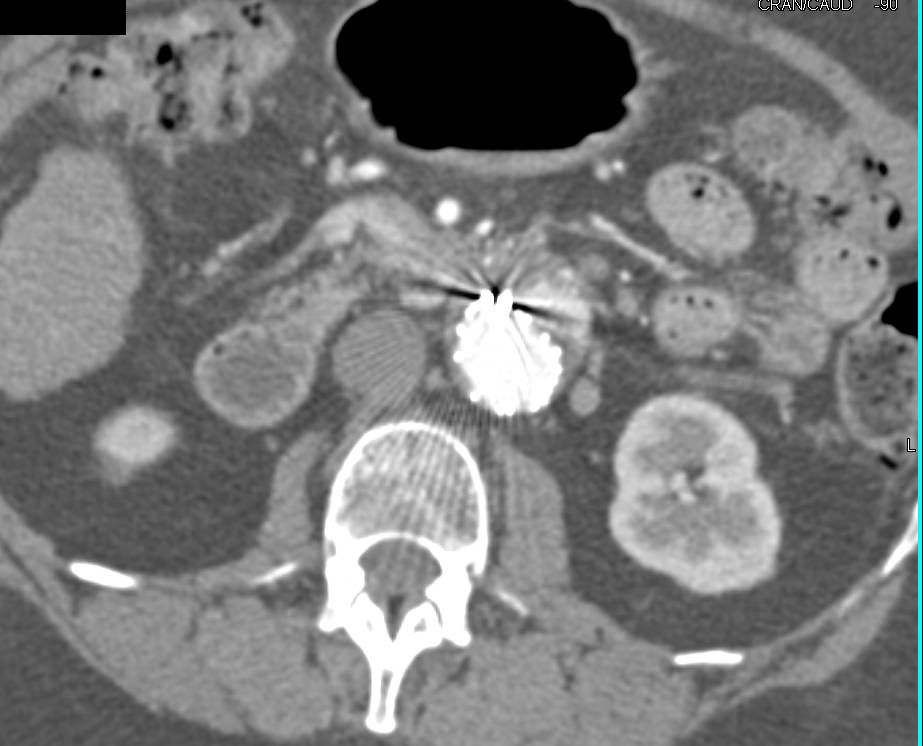 Endovascular Stent with Endoleak - CTisus CT Scan