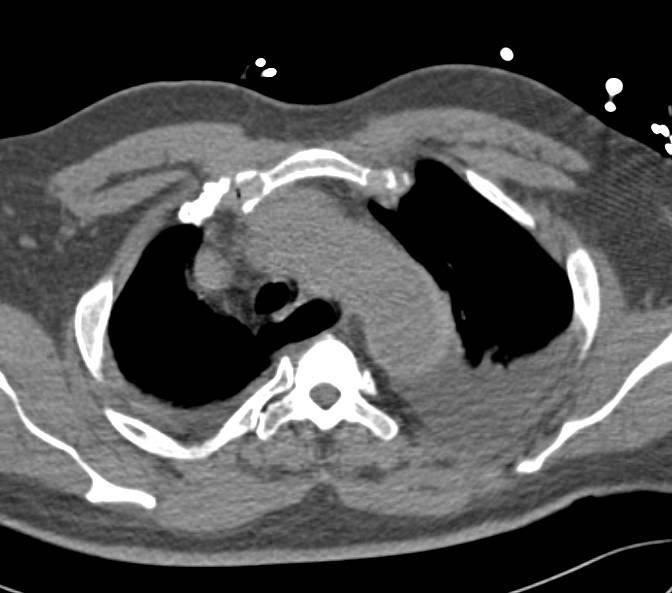 Excellent Example of Aortic Dissection with Intramural Hematoma Best Seen on Non-contrast CT - CTisus CT Scan