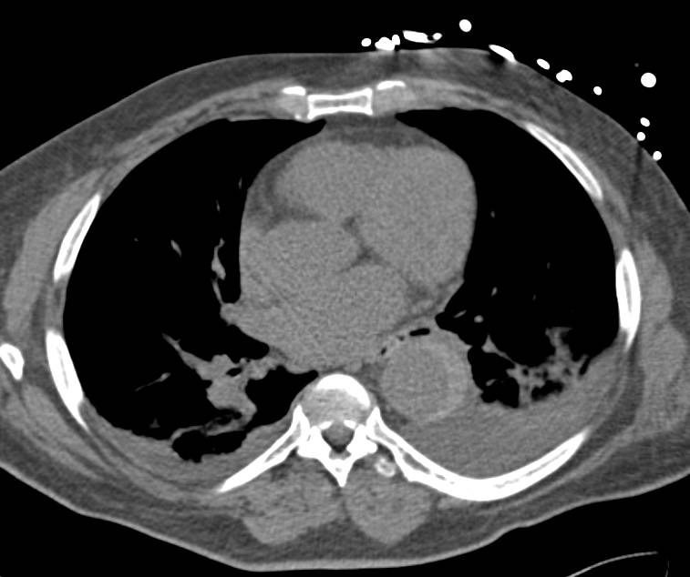 Excellent Example of Aortic Dissection with Intramural Hematoma Best