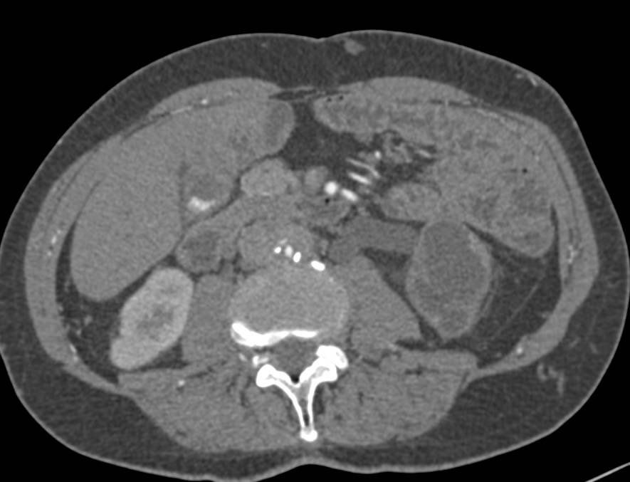 Retroperitoneal Fibrosis with Encased Aorta and Proximal Renal Arteries - CTisus CT Scan