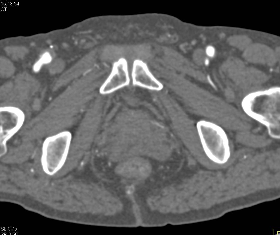 CTA Runoff with Occlusion of Vascular Grafts Using Bone Removal Techniques - CTisus CT Scan