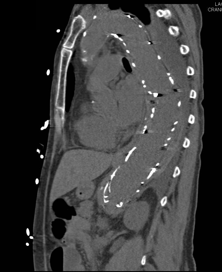 Endovascular Stent with Endoleak Seen on both Early and Late Phase Images - CTisus CT Scan