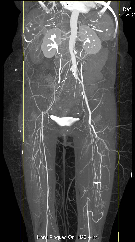 Runoff with Dual Energy and Multiple Stenosis Done with Plaque Removal - CTisus CT Scan