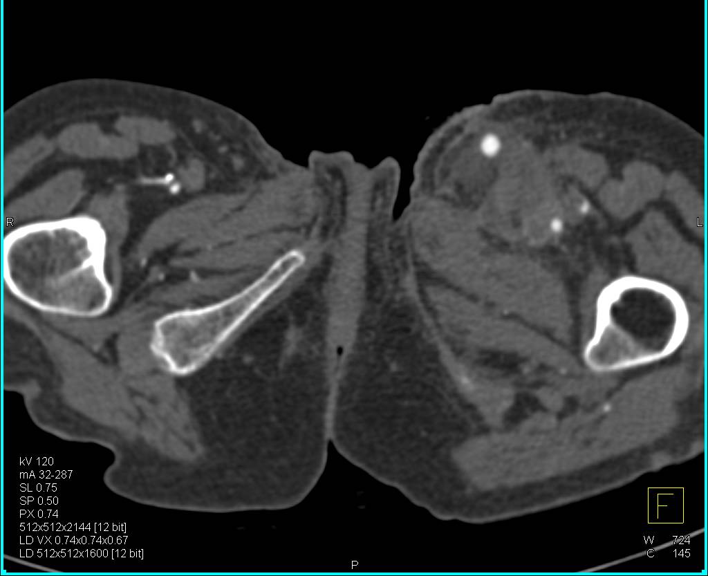 CTA Runoff with Stents and Grafts for Peripheral Vascular Disease (PVD) - CTisus CT Scan