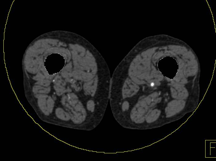 Dual Energy CT with Automated Bone Removal Nicely Shows Peripheral Vascular Disease (PVD) - CTisus CT Scan