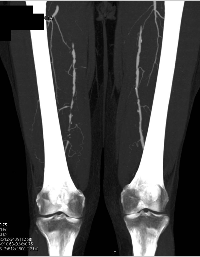 Peripheral Vascular Disease Evaluated with CTA Runoff with Bone Removal Technique - CTisus CT Scan