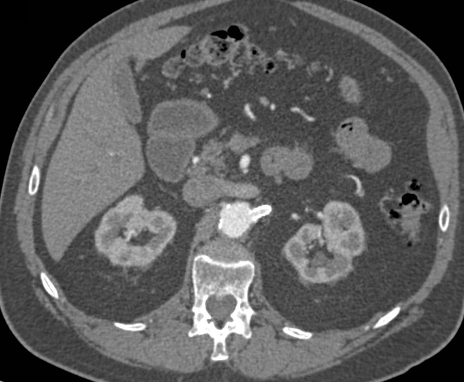 Endovascular Stent with Endoleak Seen on both Early and Late Phase Images - CTisus CT Scan