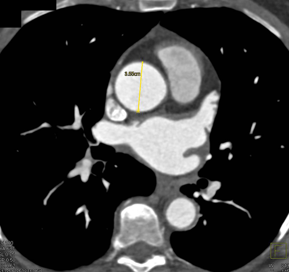 Incidental Indeterminate 1 cm Right Renal Mass in a Patient Evaluated for an Aortic Aneurysm - CTisus CT Scan