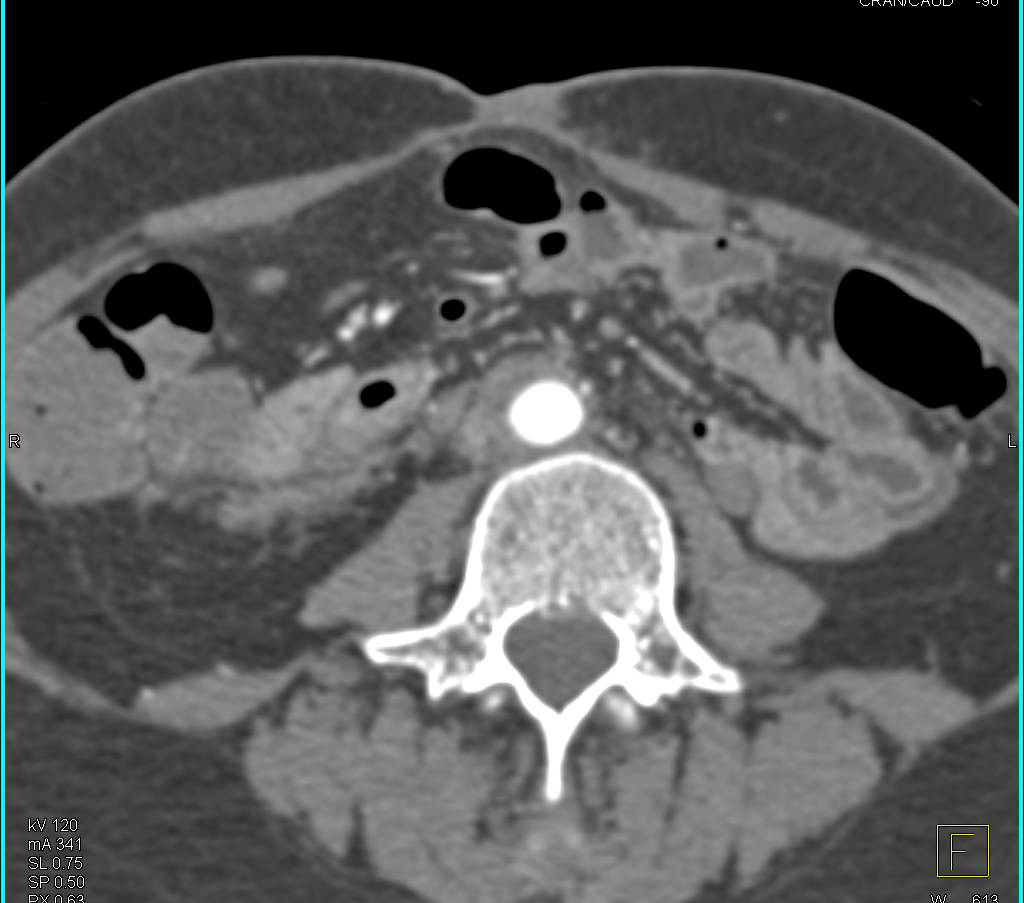 Retroperitoneal Fibrosis Encases the Aorta with Grafts Used for Vessel Patency - CTisus CT Scan