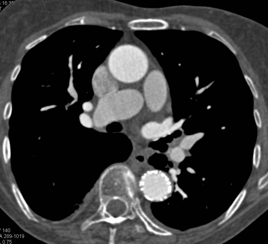 Endovascular Stent in Descending Thoracic Aorta without Complication - CTisus CT Scan