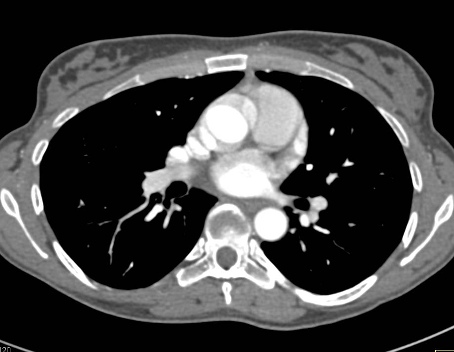 Pseudo-Dissection Ascending Aorta due to Motion Artifact - CTisus CT Scan
