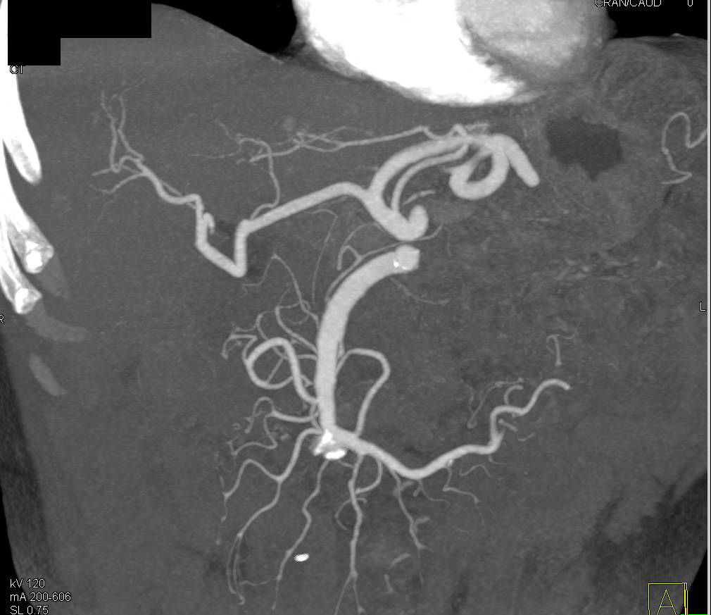 MIP Display of Superior Mesenteric Artery (SMA) and Celiac Artery - CTisus CT Scan