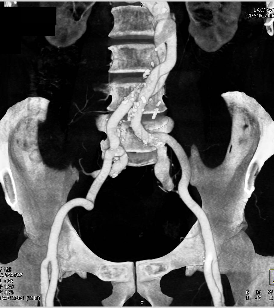 Aortic Aneurysm Repair with Aortoiliac Grafts - CTisus CT Scan