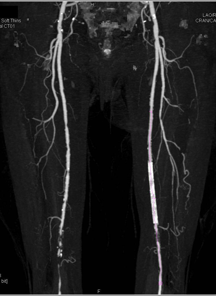 CTA Runoff with PVD (Peripheral Vascular Disease) and Stenosis as Well as Left Sided Stent with Bone Editing - CTisus CT Scan